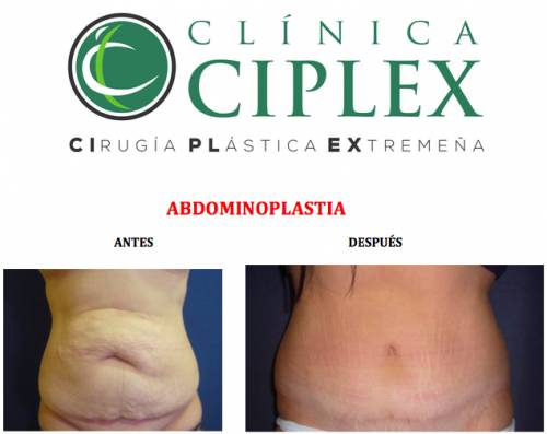 Abdominoplastia